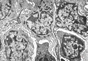  M,73y. | spleen - hairy cell leukemia